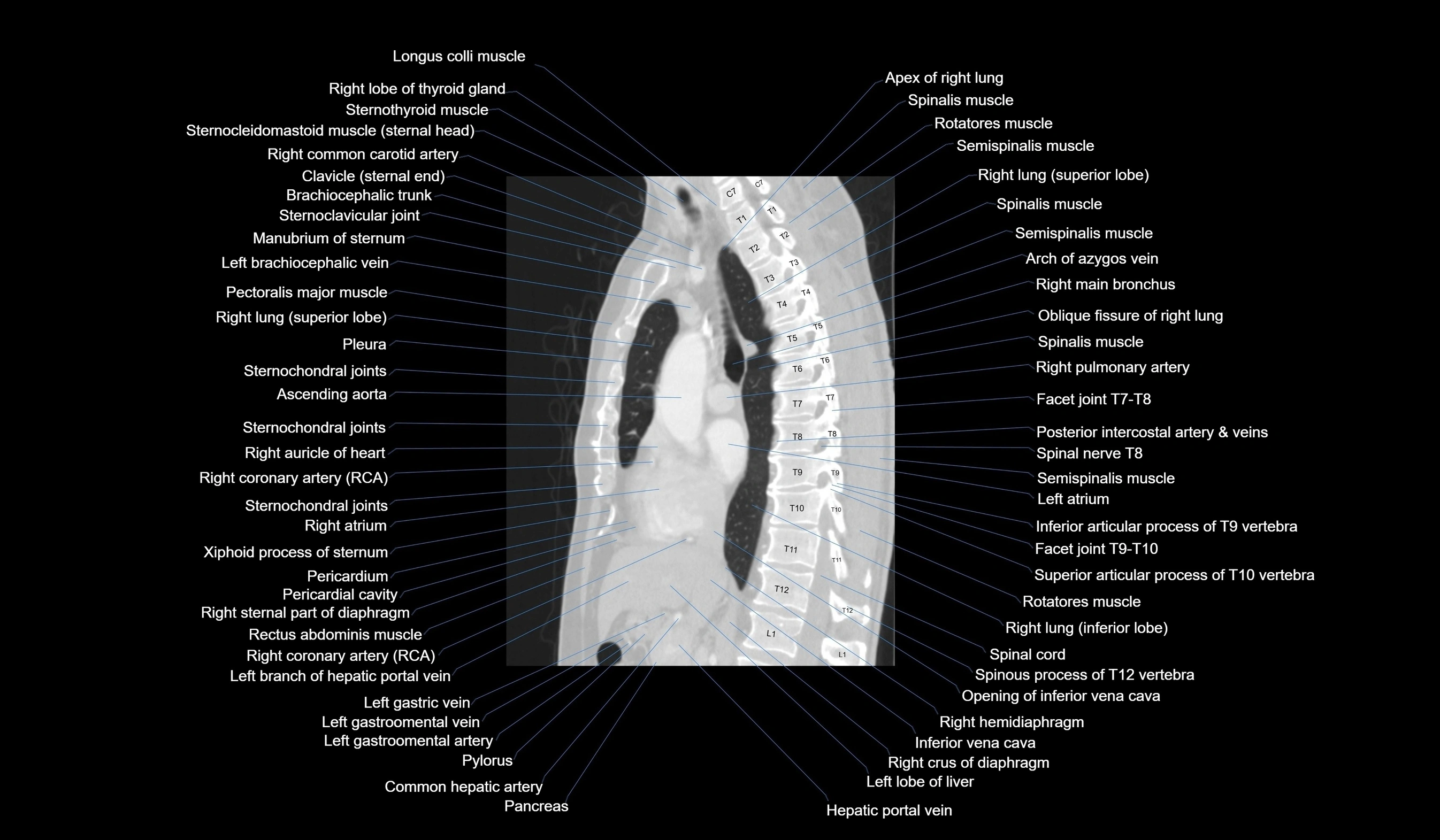 CT chest (thorax) labelled sagittal cross sectional anatomy radiology image-00070.webp